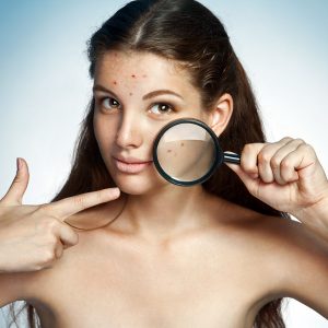 acne behandeling schoonheidsspecialist