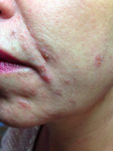 PCA peeling behandeling acne huid, korsten,overgevoelige huid
