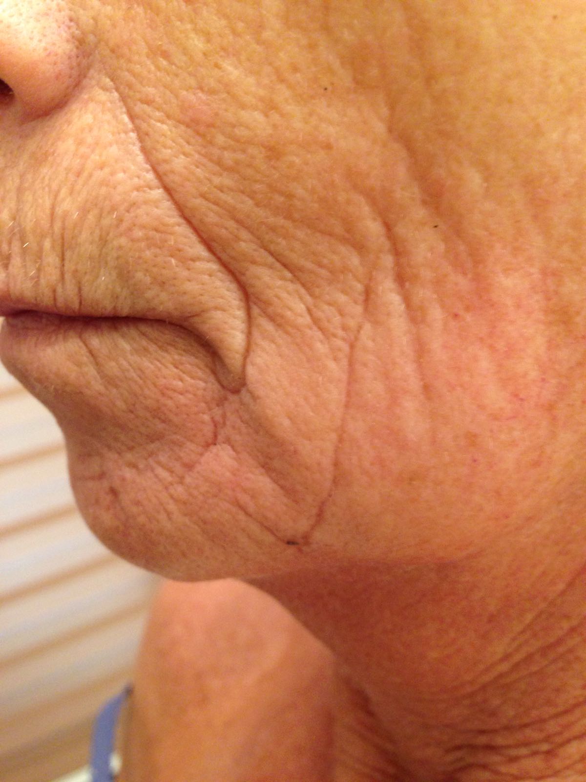 Coördineren Knooppunt Uitvoeren Wat kun je doen aan een slappe huid in het gezicht hals en kaaklijnen